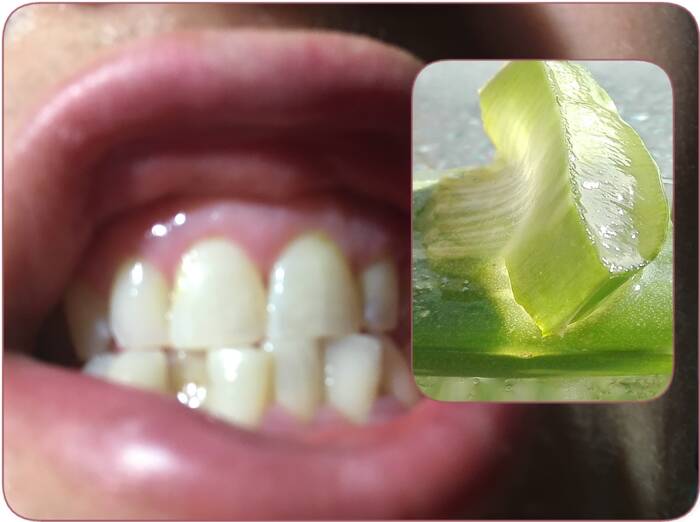 How to stop receding gum from getting worse with aloe vera