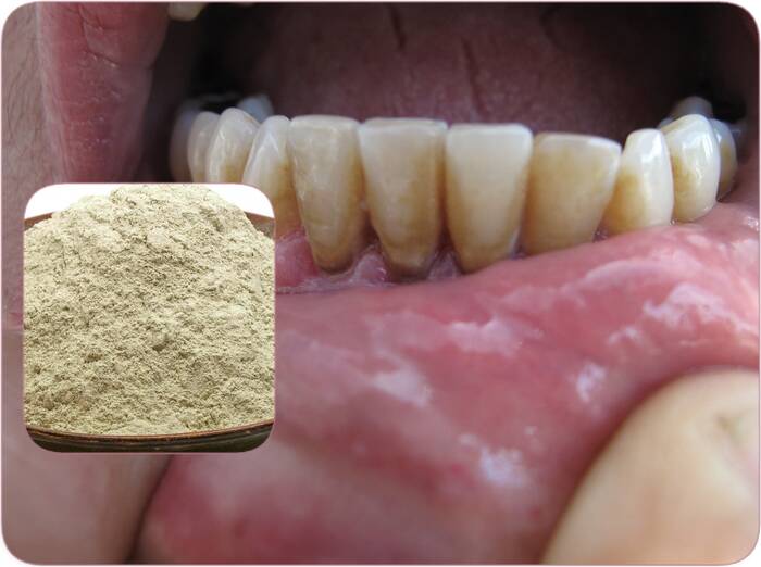 How to use bentonite clay for receding gums and tooth decay