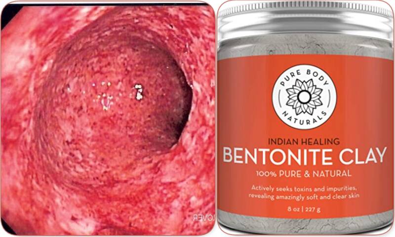 Bentonite Clay for Colitis and Crohn's disease