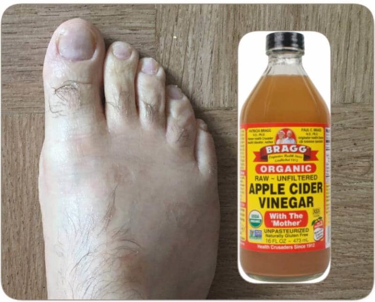 Does Apple Cider Vinegar Help Treat Gout? - Herbs And Plants For Better ...