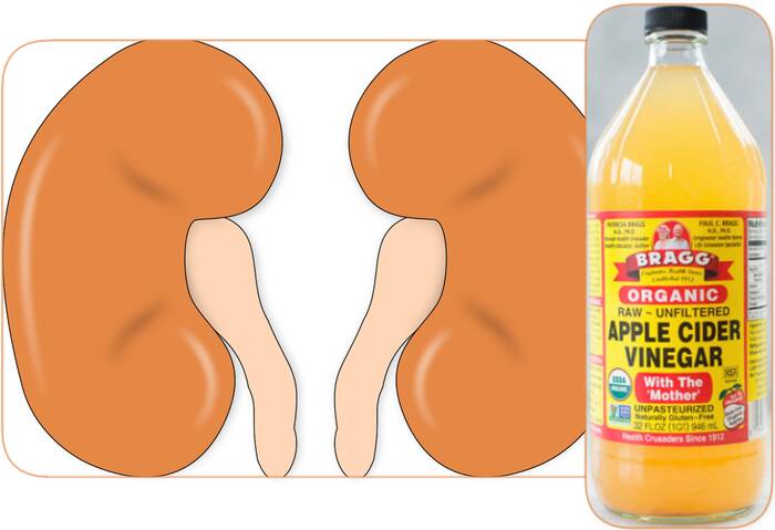 apple cider vinegar for kidney infection and kidney failure
