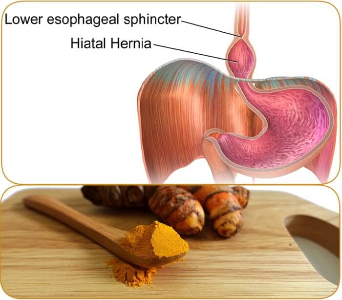 Is turmeric good for hiatal hernia