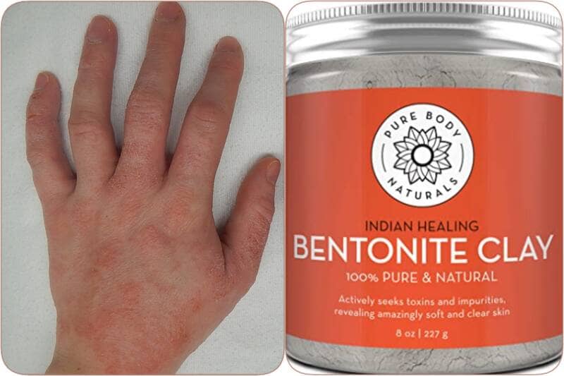 Picture for How to Treat Eczema with Bentonite Clay [+ skin benefits]