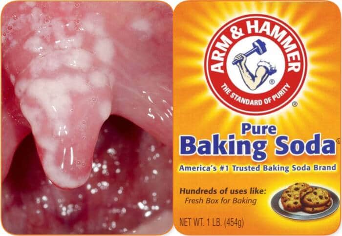 How to Treat Oral Thrush with Baking Soda