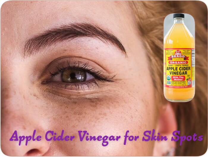 Apple Cider Vinegar for Skin Spots