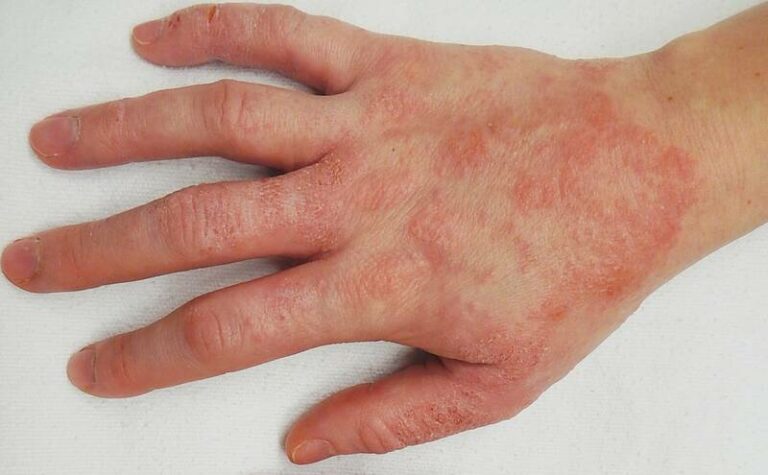 is-baking-soda-good-for-dyshidrotic-eczema